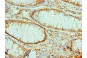 Immunohistochemistry of paraffin-embedded human colon cancer using ABIN7172290 at dilution of 1:100 (TIRAP anticorps  (AA 1-221))