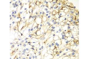 Immunohistochemistry of paraffin-embedded Human kidney cancer using VANGL2 Polyclonal Antibody at dilution of 1:100 (40x lens). (VANGL2 anticorps)
