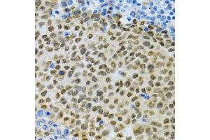 Immunohistochemistry of paraffin-embedded rat cancer using ELAVL1 Antibody.