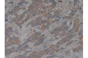 IHC-P analysis of Human Breast Cancer Tissue, with DAB staining. (CX3CL1 anticorps  (AA 25-332))