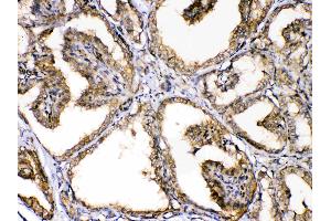 GAPDH was detected in paraffin-embedded sections of human thyroid cancer tissues using rabbit anti- GAPDH Antigen Affinity purified polyclonal antibody (Catalog # ) at 1 µg/mL. (GAPDH anticorps  (AA 136-335))