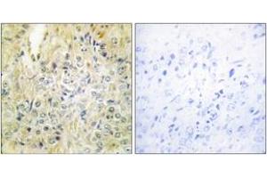 Immunohistochemistry analysis of paraffin-embedded human prostate carcinoma tissue, using DLEC1 Antibody. (DLEC1 anticorps  (AA 1-50))