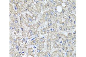 Immunohistochemistry of paraffin-embedded Human liver damage using MUC16 Polyclonal Antibody at dilution of 1:100 (40x lens). (MUC16 anticorps)