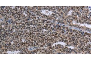Immunohistochemistry of paraffin-embedded Human ovarian cancer tissue using MAGEC1 Polyclonal Antibody at dilution 1:30 (MAGEC1 anticorps)