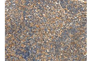 The image on the left is immunohistochemistry of paraffin-embedded Human tonsil tissue using ABIN7192438(SLC24A6 Antibody) at dilution 1/20, on the right is treated with synthetic peptide.