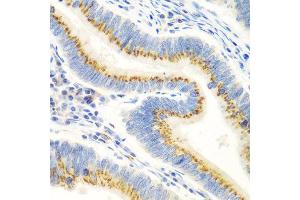 Immunohistochemistry of paraffin-embedded human colon carcinoma using UBIAD1 antibody at dilution of 1:100 (40x lens). (UBIAD1 anticorps)