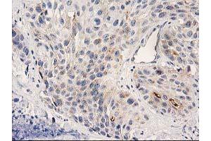 Immunohistochemical staining of paraffin-embedded Carcinoma of Human bladder tissue using anti-PLEKHA3 mouse monoclonal antibody. (PLEKHA3 anticorps)