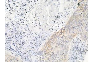ABIN6260936 and ABIN6266533 at 1/100 staining human cervical carcinoma by IHC-P.