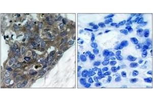 Immunohistochemistry analysis of paraffin-embedded human breast carcinoma tissue, using ASK1 (Ab-966) Antibody.