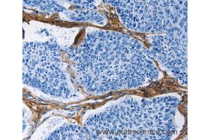 Immunohistochemistry of Human prostate cancer using COL3A1 Polyclonal Antibody at dilution of 1:60 (COL3A1 anticorps)