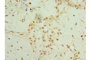 Immunohistochemistry of paraffin-embedded human breast cancer using ABIN7159637 at dilution of 1:100 (TET2 anticorps  (AA 1833-2002))