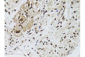 Immunohistochemistry of paraffin-embedded human colon carcinoma using STK11 antibody.