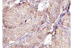 ABIN6277590 at 1/100 staining Human breast cancer tissue by IHC-P. (HSD17B10 anticorps  (Internal Region))