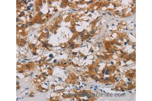 Immunohistochemistry of Human thyroid cancer using CNDP1 Polyclonal Antibody at dilution of 1:30 (CNDP1 anticorps)