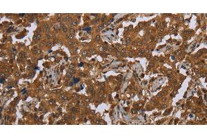 Immunohistochemistry of paraffin-embedded Human liver cancer tissue using SCGB1D2 Polyclonal Antibody at dilution 1:40 (SCGB1D2 anticorps)
