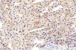 Immunohistochemistry analysis of paraffin-embedded human liver cancer using PSMD8 (ABIN7075226) at dilution of 1: 2600