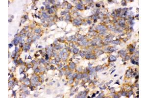 Anti- OPA1 Picoband antibody, IHC(P) IHC(P): Human Lung Cancer Tissue