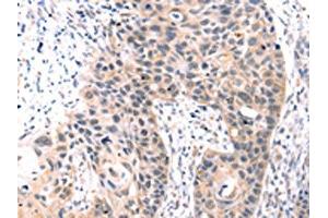 The image on the left is immunohistochemistry of paraffin-embedded Human esophagus cancer tissue using ABIN7192749(TCERG1L Antibody) at dilution 1/30, on the right is treated with synthetic peptide. (TCERG1L anticorps)