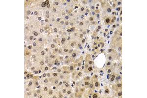 Immunohistochemistry of paraffin-embedded human liver cancer using MAGE-1/MA antibody (ABIN6132325, ABIN6143435, ABIN6143436 and ABIN6221133) at dilution of 1:200 (40x lens).