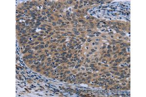 Immunohistochemistry of Human cervical cancer using AVEN Polyclonal Antibody at dilution of 1:30 (AVEN anticorps)