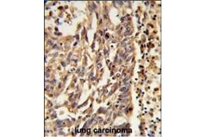 Formalin-fixed and paraffin-embedded human lung carcinoma reacted with KIF11 Antibody (N-term), which was peroxidase-conjugated to the secondary antibody, followed by DAB staining.