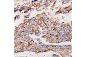 Formalin-fixed and paraffin-embedded human lung carcinoma tissue reacted with CD107a / LAMP1 Antibody (N-term) followed which was peroxidase-conjugated to the secondary antibody, followed by DAB staining. (LAMP1 anticorps  (N-Term))