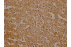 Immunohistochemistry of paraffin-embedded human breast cancer using ABIN7174308 at dilution of 1:100 (USP3 anticorps  (C-Term))