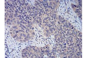 Immunohistochemical analysis of paraffin-embedded cervical cancer tissues using FOXP3 mouse mAb with DAB staining.