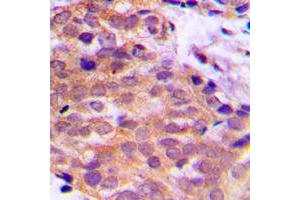 Immunohistochemical analysis of 14-3-3 theta/tau staining in human prostate cancer formalin fixed paraffin embedded tissue section.