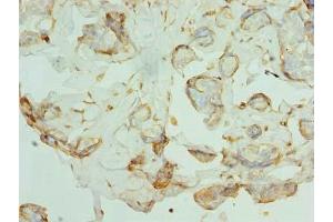 Immunohistochemistry of paraffin-embedded human breast cancer using ABIN7163824 at dilution of 1:100 (PKD1L2 anticorps  (AA 1-306))