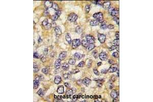 Formalin-fixed and paraffin-embedded human breast carcinoma tissue reacted with UCHL3 antibody (C-term), which was peroxidase-conjugated to the secondary antibody, followed by DAB staining. (UCHL3 anticorps  (C-Term))