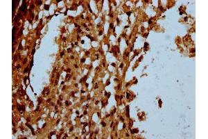 IHC image of ABIN7174180 diluted at 1:100 and staining in paraffin-embedded human melanoma performed on a Leica BondTM system. (C16orf57 anticorps  (AA 1-90))