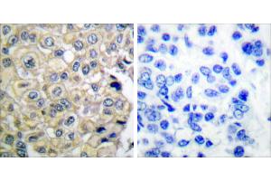 Peptide - +Immunohistochemical analysis of paraffin-embedded human breast carcinoma tissue using FGFR3 antibody. (FGFR3 anticorps)
