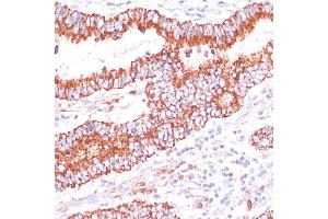 Immunohistochemistry of paraffin-embedded human colon carcinoma using ENTPD6 antibody (ABIN7266897) at dilution of 1:100 (40x lens).
