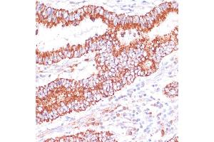 Immunohistochemistry of paraffin-embedded human colon carcinoma using ENTPD6 antibody (ABIN7266897) at dilution of 1:100 (40x lens). (ENTPD6 anticorps  (AA 61-300))