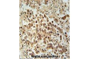VCX1 Antibody (N-term) immunohistochemistry analysis in formalin fixed and paraffin embedded human testis carcinoma followed by peroxidase conjugation of the secondary antibody and DAB staining. (VCX anticorps  (N-Term))