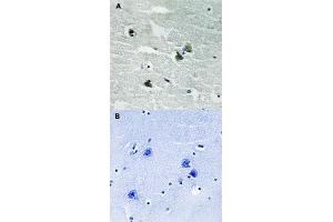 Immunohistochemical staining of human by MERTK/TYRO3 (phospho Y749/681) polyclonal antibody  without blocking peptide (A) or preincubated with blocking peptide (B) under 1:500-1000 dilution. (MERTK anticorps  (pTyr681, pTyr749))