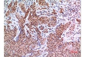 Immunohistochemistry (IHC) analysis of paraffin-embedded Human Mammary Cancer, antibody was diluted at 1:100. (EPAS1 anticorps  (Ser343))