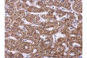 IHC-P Image SDHA antibody detects SDHA protein at cytosol on human hepatoma by immunohistochemical analysis.