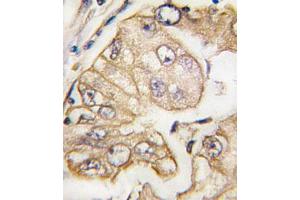 Immunohistochemical staining of formalin-fixed and paraffin-embedded human lung carcinoma tissue reacted with FLT4 monoclonal antibody  at 1:10-1:50 dilution.