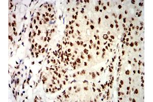Immunohistochemical analysis of paraffin-embedded bladder cancer tissues using UHRF1 mouse mAb with DAB staining. (UHRF1 anticorps  (AA 616-755))