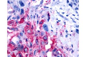 Anti-NPBWR2 / GPR8 antibody IHC of human Pancreas, Carcinoma.