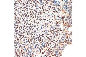 Immunohistochemistry of paraffin-embedded human esophageal cancer using KDM3B Rabbit pAb (ABIN1680577, ABIN3015976, ABIN3015977 and ABIN6219483) at dilution of 1:100 (40x lens).