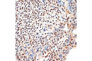 Immunohistochemistry of paraffin-embedded human esophageal cancer using KDM3B Rabbit pAb (ABIN1680577, ABIN3015976, ABIN3015977 and ABIN6219483) at dilution of 1:100 (40x lens). (KDM3B anticorps  (AA 1059-1283))