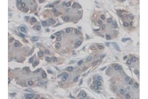 Detection of CD209 in Human Pancreatic cancer Tissue using Polyclonal Antibody to Cluster Of Differentiation 209 (CD209)