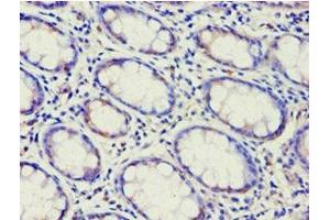 Immunohistochemistry of paraffin-embedded human colon cancer using ABIN7144925 at dilution of 1:100