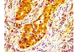 IHC image of ABIN7168283 diluted at 1:300 and staining in paraffin-embedded human pancreatic cancer performed on a Leica BondTM system.