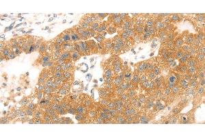Immunohistochemistry of paraffin-embedded Human breast cancer tissue using TMEFF2 Polyclonal Antibody at dilution 1:35 (TMEFF2 anticorps)
