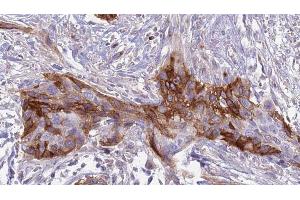 ABIN6274910 at 1/100 staining Human urothelial cancer tissue by IHC-P. (B4GALT1 anticorps  (C-Term))