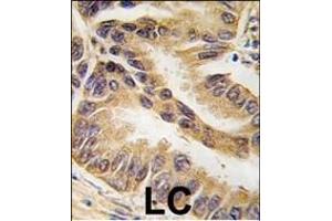 Formalin-fixed and paraffin-embedded human lung carcinoma tissue reacted with RAF1-p, which was peroxidase-conjugated to the secondary antibody, followed by DAB staining.